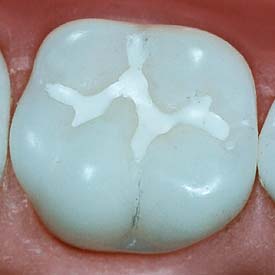 Teeth Sealants | Penhold Dental Care