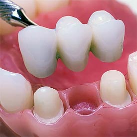 Dental Bridges | Penhold Dental Care