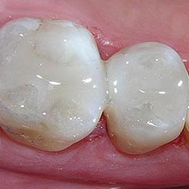 White Fillings | Penhold Dental Care