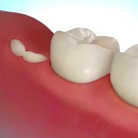 Wisdom Teeth Extraction | Penhold Dental Care