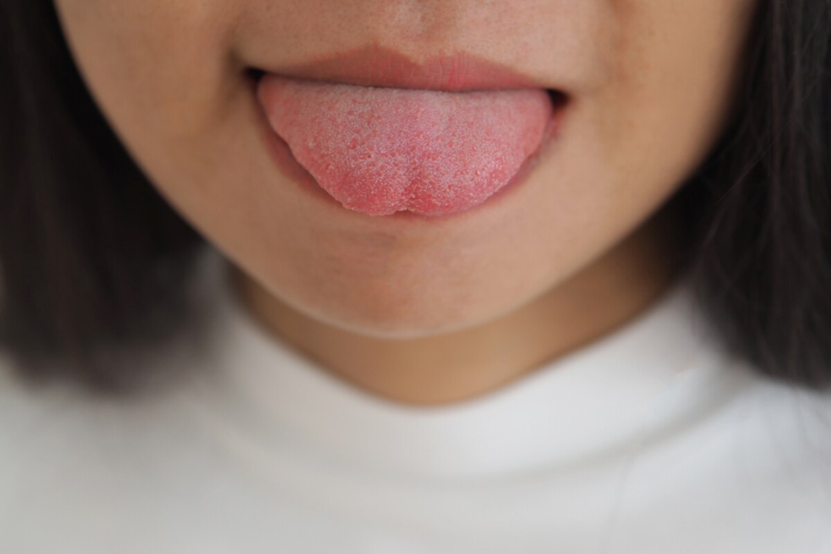 can dry mouth lead to cavities