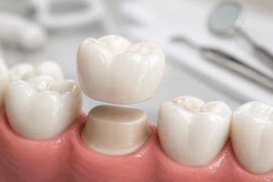 How Long Do Dental Crowns Last